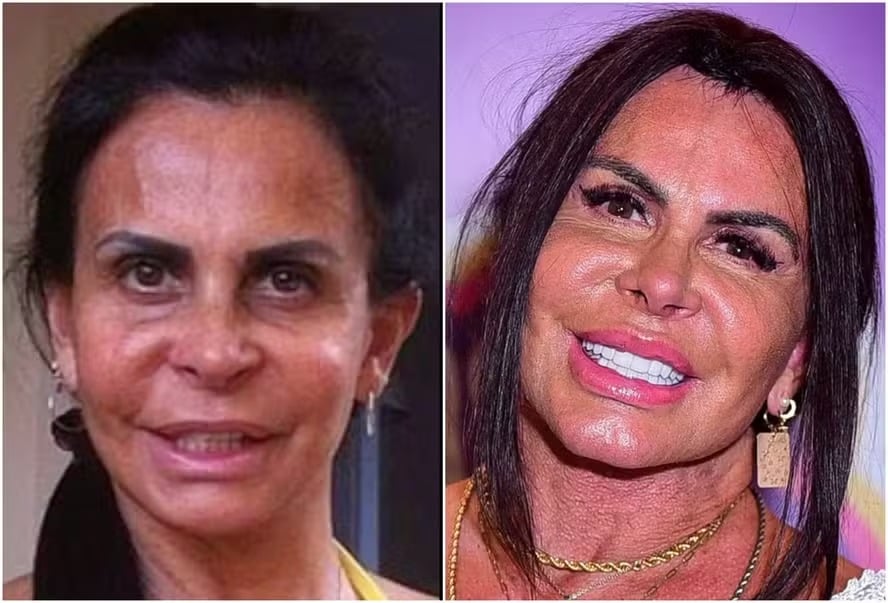 Gretchen antes e depois (Reprodução/Instagram)